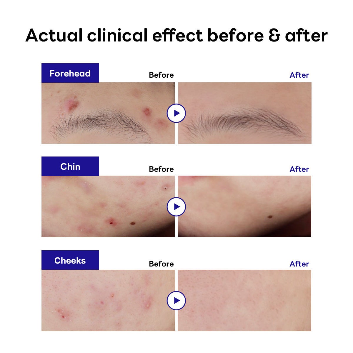 MEDIHEAL Derma Clear Teatree Trouble Spot Patch